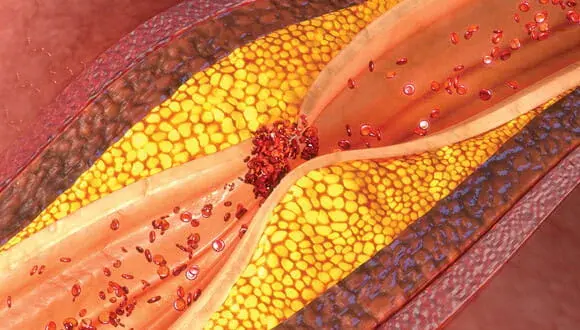 plaque-reversal-treatment